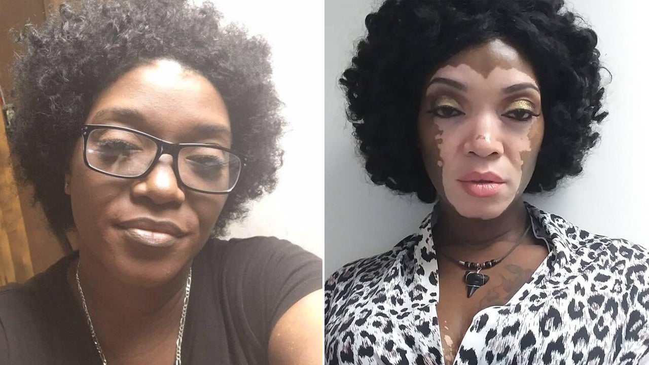 for makeup natural kids Woman of Vitiligo Under Embraces Hiding After Years Her 30