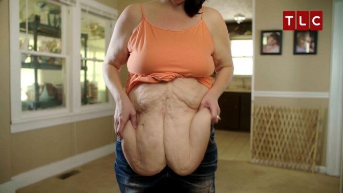 Woman Bravely Shows Sagging Skin After Losing 246 Pounds ...