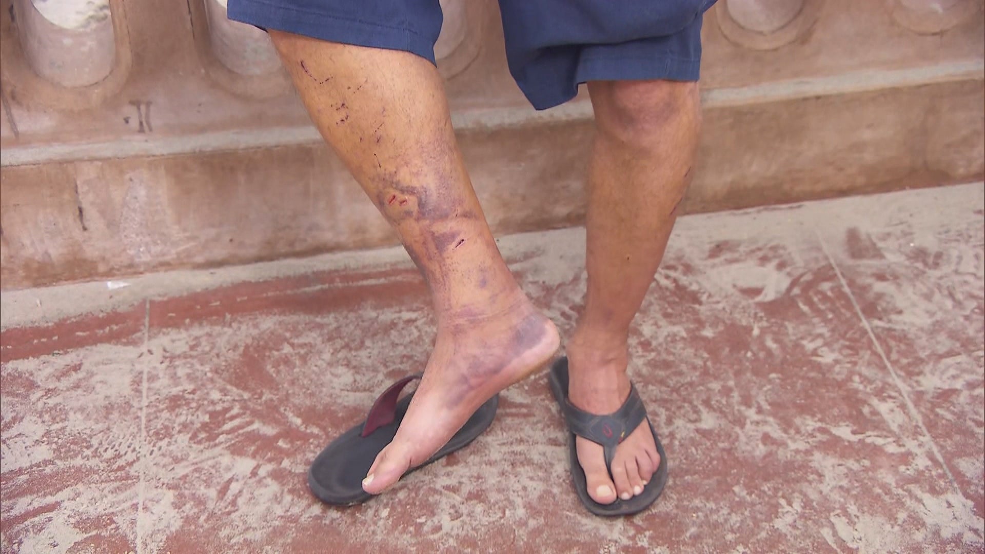 Puncture Wounds After Sea Lion Attack