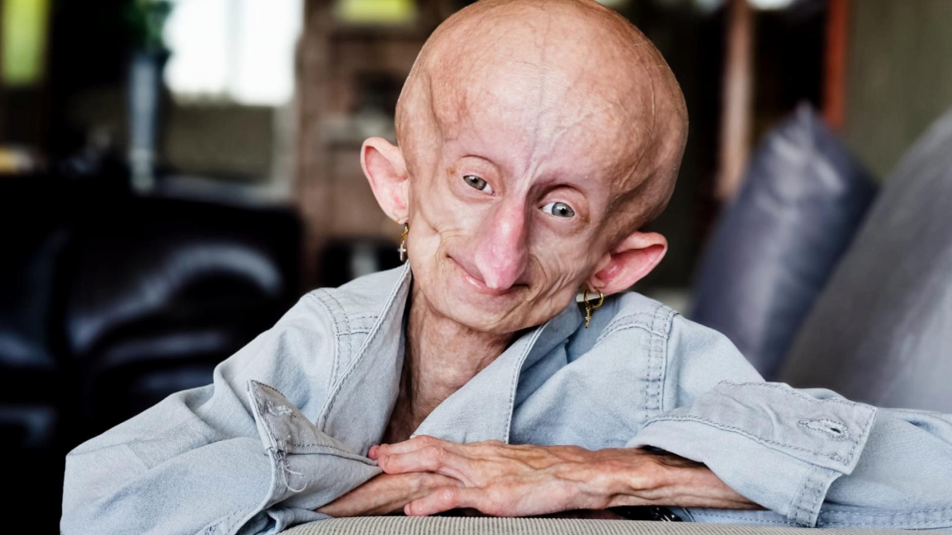 Inspirational teen TikToker, Beandri Booysen, who lived with the rare genetic disease Progeria, has died at the age of 19.