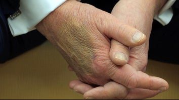 President Trump Has Large Bruise on His Hand