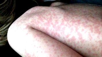 More Measles Cases Reported in New York City