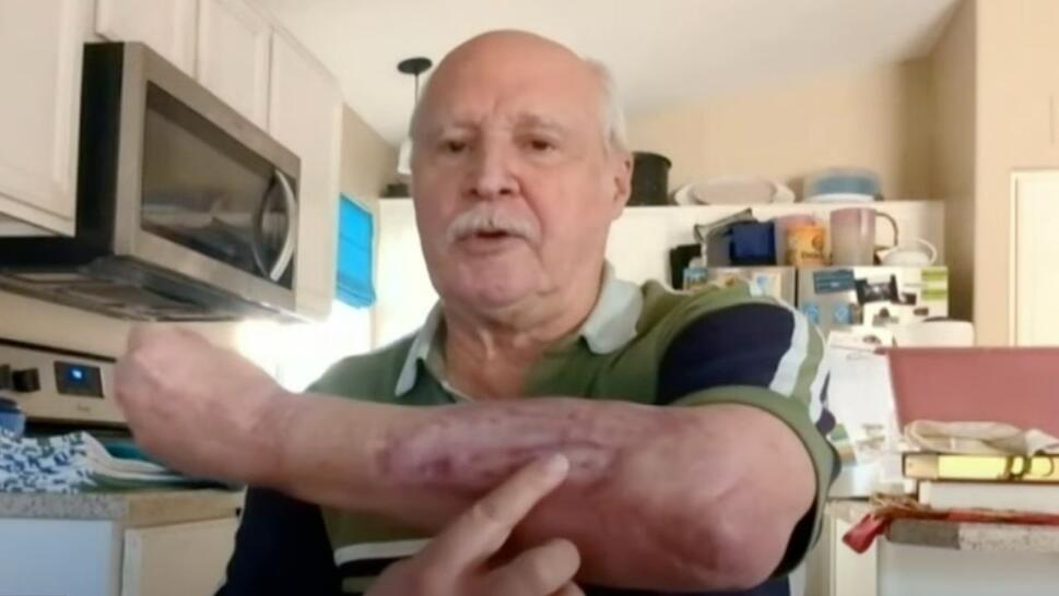 Robert Woolley, 71, points to burn on his forearm