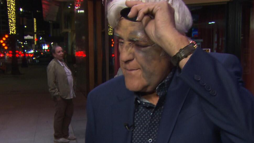 Jay Leno Gets Swollen Eye 