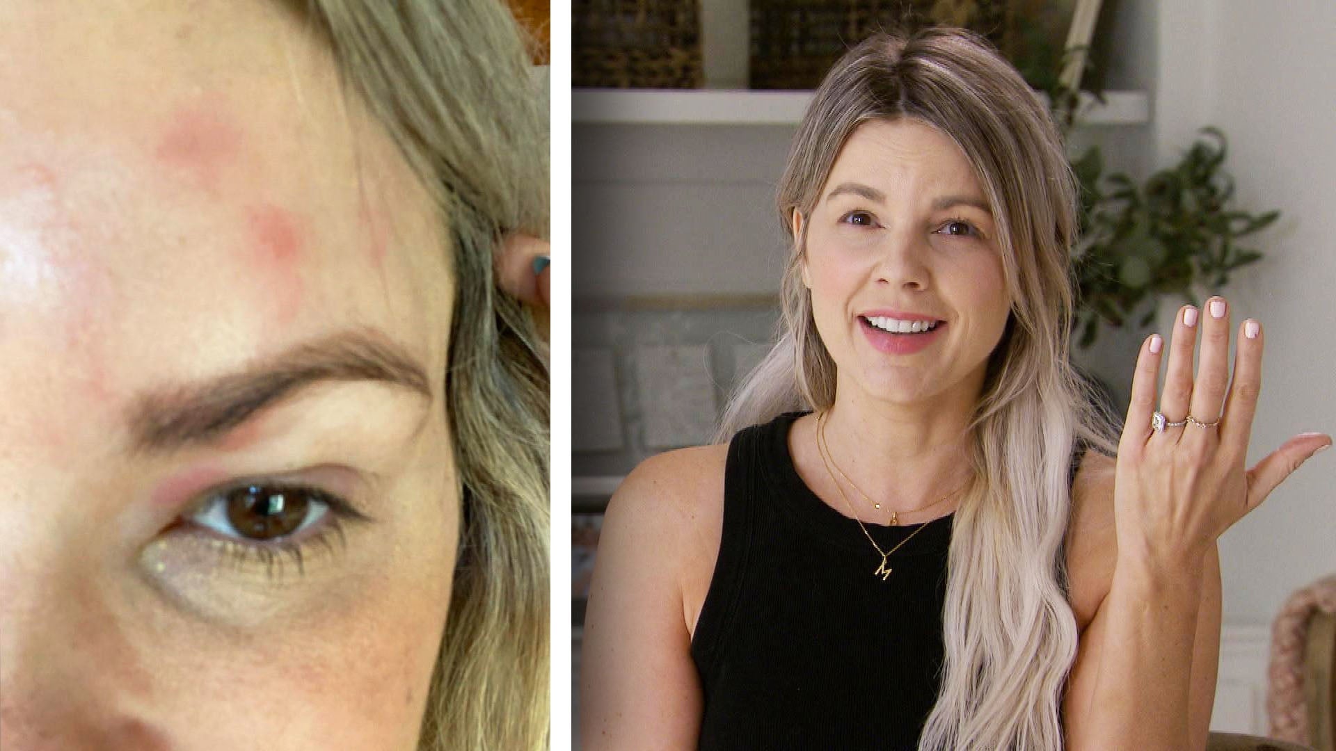 Bachelorette' Ali Fedotowsky Reveals She Has Shingles at 36 Years Old