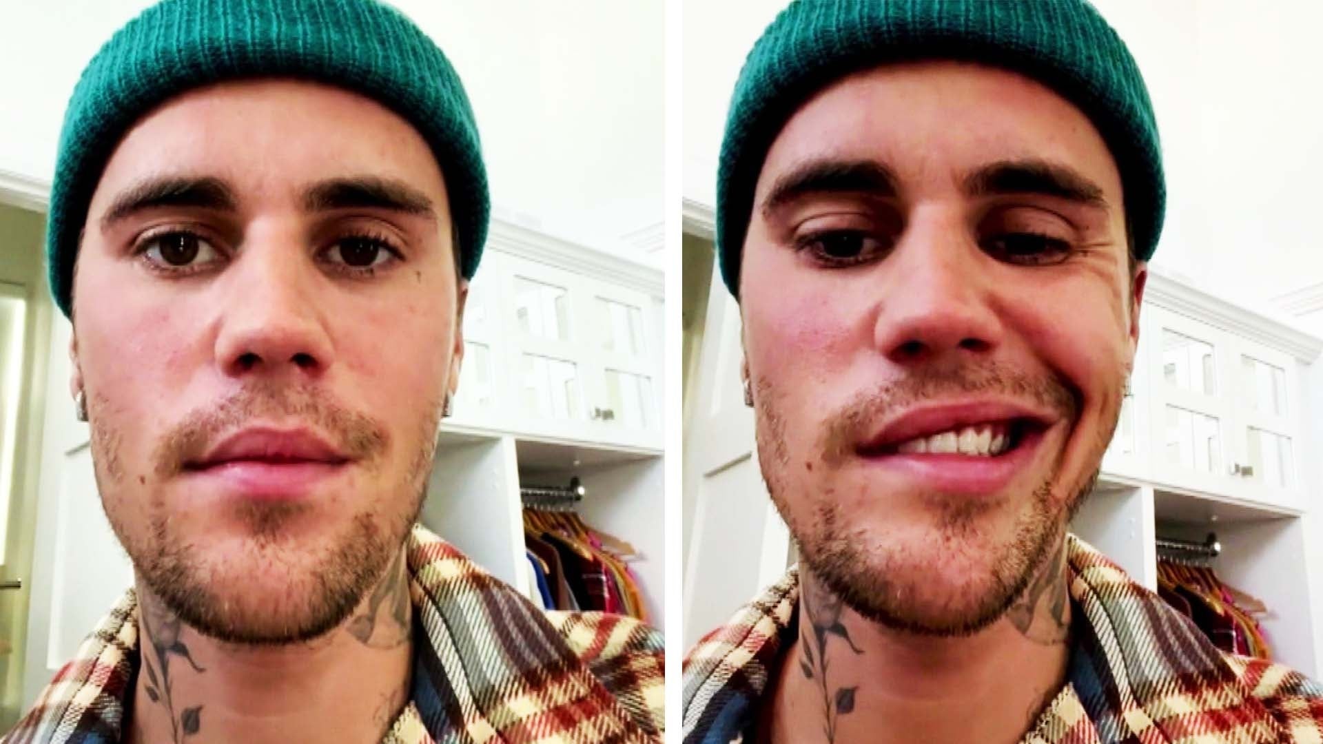 Justin Bieber Says Half His Face Is Paralyzed Inside Edition